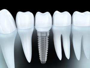 full mouth dental implants in tampa