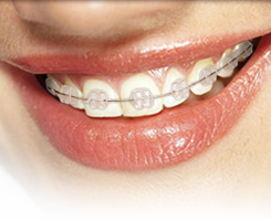 Everything You Need to Know About Dental Ceramic Braces 