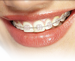 Everything You Need to Know About Dental Ceramic Braces – Escapade en ...